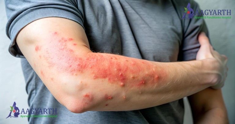 URTICARIA