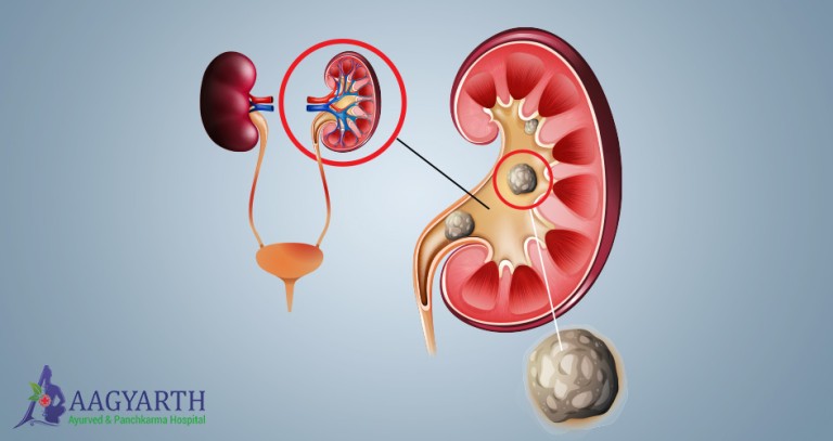 Kidney Stone